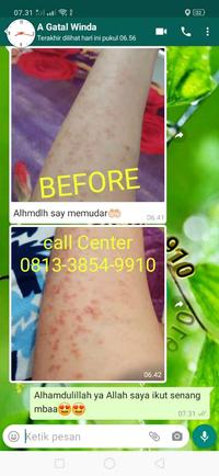 Gambar Obat gatal selangkangan dan buah zakar paling ampuh asli di Apotik dari Tabib Herbal Tradisional undefined 3 Tokopedia