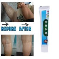 Gambar koyo salep obat varises herbal varicose veins patch ointment - KOYO dari sinarberkat168 undefined 4 Tokopedia