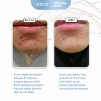 Gambar Pimp My Pimple Serum dari Soera Skin undefined 4 Tokopedia