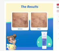 Gambar EMINA Ms Pimple Acne Solution Calming Gel 20ml dari HNCbeauty undefined 4 Tokopedia