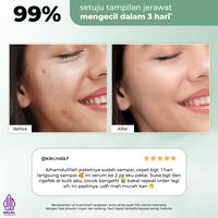 Gambar White Story Acne Set - Paket Wajah Atasi Jerawat dari White Story undefined 4 Tokopedia