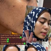 Gambar Glamshine Paket Acne dari Glamshine.tangsel undefined 2 Tokopedia