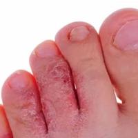 Gambar Obat salep kutu air di kaki kulit paling manjur ampuh racik spesialis dari SIGMA MANDIRI undefined 4 Tokopedia