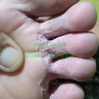 Gambar Obat salep kutu air di kaki kulit paling manjur ampuh racik spesialis dari SIGMA MANDIRI undefined 2 Tokopedia