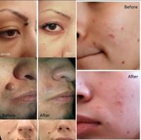 Gambar Obat Penghilang Kutil basmi Daging Tumbuh Ampuh Skin TAG Remover ORI dari Jojoho undefined 2 Tokopedia
