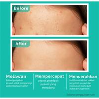 Gambar Animate Acne Solution Series 5in1 Paket Perawatan Acne dari Ultraa Beauty undefined 5 Tokopedia