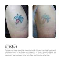 Gambar NEATCELL Pemancar Laser Picosecond untuk Menghapus Tato / Pensil Penghilang Benjolan - Merah dari PastiLakuJkt undefined 4 Tokopedia
