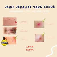 Gambar UC HYDROCOLOID ACNE PIMPLE PATCH - STARGAZING dari Modestoshop undefined 5 Tokopedia