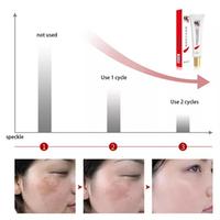 Gambar Cream Penghilang Flek Cindynal Cream Penghilang Jerawat Cream Penghila dari Shopaholicurban undefined 4 Tokopedia