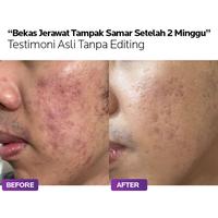 Gambar Aizen Elixskin - Cream Penghilang Bekas Jerawat Paling Ampuh & Cepat - Bekas Ringan dari Aizen Dermalogy undefined 5 Tokopedia