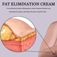 Gambar Obat Benjolan Lipoma Cream di Leher di Tangan di Punggung Segala 30Gr - South Moon dari Unelhoe Beauty Store undefined 5 Tokopedia