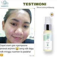 Gambar SERUM ACNE ATASI JERAWAT MERADANG DAN BRUNTUSAN BREAKOUT dari Lianybeauty undefined 5 Tokopedia