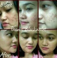 Gambar SABUN WAJAH BLACK WALET BPOM MENGHILANGKAN JERAWAT FLEK HITAM BEKAS LUKA N=MENCERAHKAN KULIT WAJAH dari GOODJOOBS undefined 5 Tokopedia