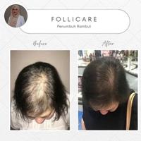 Gambar Follicare Asli Original Serum Penumbuh Rambut Botak Terbaik dari ALUNG-SHOP-88 undefined 5 Tokopedia
