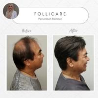 Gambar Follicare Asli Original Serum Penumbuh Rambut Botak Terbaik dari ALUNG-SHOP-88 undefined 3 Tokopedia