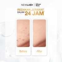 Gambar NEWLAB Paket 2 Botol Acnalogy Acne Gel | Obat Totol Jerawat dan Bekas Jerawat | Acne Spot | Serum Jerawat 10ml dari Newlab_NEW undefined 5 Tokopedia
