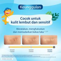Gambar DERMATIX ULTRA KIDS 9GR BEKAS LUKA ANAK SCAR CARE MENARINI SENSITIF dari Toko Obat Palembang Bandung undefined 2 Tokopedia