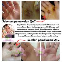 Gambar Obat Pengering Pasca Operasi - Obat Luka Setelah Melahirkan Caesar dari Abimantra Herbal undefined 3 Tokopedia