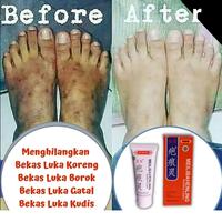 Gambar Ampuh salep krim penghilang bekas luka flek hitam original dari Qonita Herbal Store undefined 3 Tokopedia