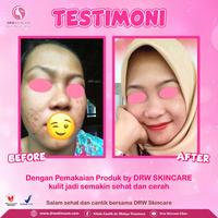 Gambar drw skincare acne bright Paket Radiant Acne Brightening isi 3 Untuk Memudarkan Bekas Jerawat Menghilangkan flek Menyamrkan pori dari drwskincarebekasi03 undefined 2 Tokopedia