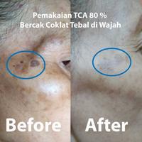 Gambar Kutil.go Kadar 80% 10 ml untuk Kutil Kelamin dari momokun undefined 3 Tokopedia
