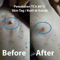 Gambar Kutil.go Kadar 80% 10 ml untuk Kutil Kelamin dari momokun undefined 4 Tokopedia