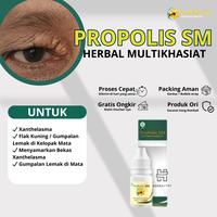 Gambar Obat Xanthelasma Penghilang Gumpalan Lemak di Kelopak Mata Salep Milia Bintik Di Dekat Mata Herbal ProPolis SM dari Herbalthy Store undefined 1 Tokopedia