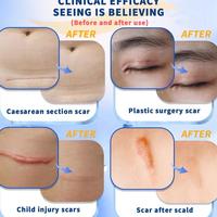 Gambar Mantap Netpac 100%Original Dermatix Penghilang Bekas Luka Koreng Advanced Scar Gel Dermatik Obat Bekas Luka Luka Jahitan Bekas Luka Jerawat Dan Stretch Marks Penghilang Strechmark Ampuh 15G dari arasiteru undefined 2 Tokopedia