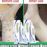 Gambar Mantap Netpac 100%Original Dermatix Penghilang Bekas Luka Koreng Advanced Scar Gel Dermatik Obat Bekas Luka Luka Jahitan Bekas Luka Jerawat Dan Stretch Marks Penghilang Strechmark Ampuh 15G dari arasiteru undefined 5 Tokopedia
