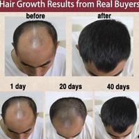 Gambar serum penumbuh rambut paling ampuh 30ml,penumbuh rambut botak pria,serum rambut rontok rusak,penumbuh rambut cepat,serum penumbuh rambut botak,obat rambut rontok parah wanita,vitamin penumbuh rambut botak dari Handst Beauty undefined 3 Tokopedia