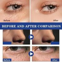 Gambar Serum penghilang MILIA dibawah mata remover serum dari Litha'Shop undefined 3 Tokopedia