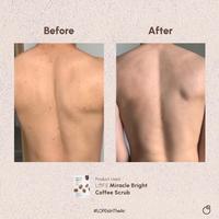 Gambar New LOFE Miracle Coffee Scrub FRANK BODY / TIFF BODY BUT BETTER - BRIGHTENING NATURAL by LOFE MENGATASI JERAWAT, STRETCHMARKS, LIPATAN GELAP, MENCERAHKAN, LULUR REMPAH BEDDA LOTONG AYAM CHICKEN STRAWBERRY SKIN - Bisa untuk Wajah Badan Punggung Memutihkan dari popay olshoppp undefined 2 Tokopedia