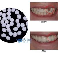 Gambar GIGI PALSU SEMENTARA 200 BUTIR / PENAMBAL GIGI PATAH RENGGANG TEMPORARY TOOTH TEMPTOOTH GINGSUL PATAH KELINCI / Snap On Smile Instan / Bahan Tambal Tambalan Lem Gigi Tiruan / Temporary Tooth Lem Gigi Original dari Behelldental Official undefined 5 Tokopedia