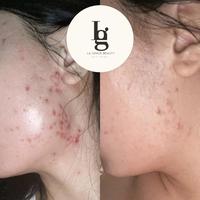 Gambar La Grace Beauty 24K Bio Gold Cleanser - 120ml x 3 dari Oasis glow12 undefined 4 Tokopedia