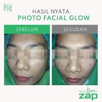 Gambar Photo Facial Glow - ZAP Clinic dari DaN-DaN Official undefined 5 Tokopedia