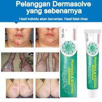 Gambar (PRIVASI) Jemeesen psoriasis krim skrotum gatal ruam ruam dermatitis eksim pengobatan p antibiotik herbal tinea pedis menghambat jamur - 1PC dari Pendekar Maya undefined 2 Tokopedia