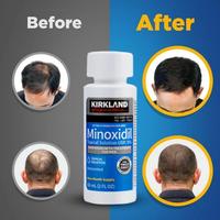Gambar Kirkland Minoxidil 5 2Biotin 10.000mcg isi 100 paket 2 bln dari FANIERA_STORE undefined 4 Tokopedia