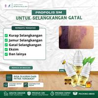 Gambar Cairan Oles Penghilang Kurap Selangkangan, Salep Gatal Selangkangan, Jamur Selangkangan, Eksim Selangkangan, Pencerah Selangkangan Hitam Dan Gelap Dengan Propolis dari kiaherbal undefined 1 Tokopedia