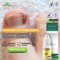 Gambar Propolis Sm Obat Cantengan Jempol Kaki Bengkak dan Nyeri Perawatan Kuku Kapalan Tangan dan Kaki Kering dari Mitana Herbal undefined 1 Tokopedia