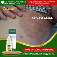 Gambar Untuk Gatal Selangkangan, Selangkangan Menghitam dan Gatal, Infeksi Jamur Selangkangan, Babak Selangkangan, Jamur Selangkangan, Selangkangan Hitam, Kurap Selangkangan, Salep Gatal Selangkangan, Gatel Selangkangan dari Rino Herbal Shop undefined 1 Tokopedia