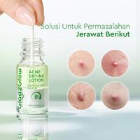 Gambar [NEW LAUNCH] GLAD2GLOW Acne Drying Lotion Mengeringkan Jerawat 8 Jam Dengan Sulfur BHA & Bahan Alami Instant Acne Care Acne Patch Jerawat Skincare Wajah G2G dari Glad2Glow Official Store undefined 3 Tokopedia