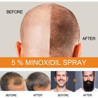 Gambar Serum Pertumbuhan Kebotakan Cepat, Obat Pertumbuhan Rambut, Pertumbuhan rambut, Pertumbuhan Rambut Cepat, Anti Rambut Rontok, Semprotan Pertumbuhan Rambut 30ml untuk Rambut Rontok Parah, Rambut Menipis, Serum Penumbuh Rambut Paling Ampuh dari Toko Meog undefined 5 Tokopedia