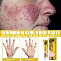 Gambar Salep/Cream south moon Original untuk Gatal Membandel Eksim, Psoriasis, Kurap, Gatal Selangkangan, Gatal Alergi, Scabies, Kutu Air, Jamur - 1pcs dari Mekar Cantik undefined 5 Tokopedia