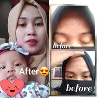 Gambar Platinum ACNE/NORMAL PLATINUM SHIMMER AND SHINE BYLA BEAUTY - Normal platinum dari Shimmer and Shine by Byla Beauty undefined 3 Tokopedia