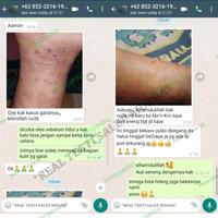 Gambar Salep Bidara Sirih Obat Gatal Selangkangan Jamur Eksim Jerawat dari Janhijab undefined 3 Tokopedia