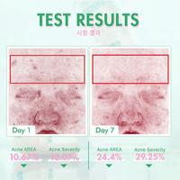 Gambar BNB barenbliss Pimple Warrior! Salicylic Acid Acne Drying Lotion dari Litchi Skin undefined 3 Tokopedia