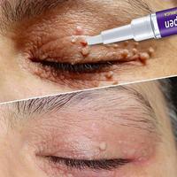 Gambar EELHOE Krim Penghilang Kutil 5Ml, Krim Penghilang Kutil Lalat Badan, dari DEA STORE NEWS undefined 1 Tokopedia