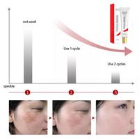Gambar BPOM CINDYNAL Penghilang Flek Bintik Noda Hitam Whitening Freckle dari vonzy shop undefined 5 Tokopedia