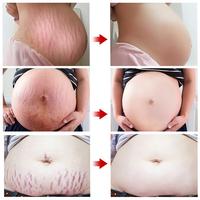 Gambar STRECHMARK CREAM Krim Stretch Mark Pascamelahirkan PENGHILANG dari Marjeta Nadine undefined 3 Tokopedia