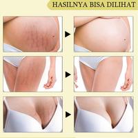 Gambar STRECHMARK CREAM Krim Stretch Mark Pascamelahirkan PENGHILANG dari Marjeta Nadine undefined 4 Tokopedia